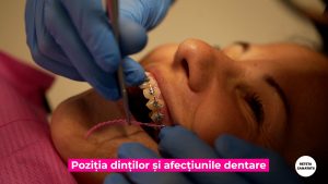 PARODONTITA-TRATATA-ORTODONTIC.00_01_14_32.Still004