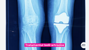 BOALA-ARTROZICA-DR-OJOGA.00_00_11_36.Still005