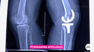 PROTEZAREA-ARTICULARA.00_00_46_21.Still004