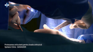 Protezarea-articulara-pentru-boala-artrozica.00_00_18_26.Still002