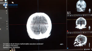 MALFORMATII-VASCULARE-CEREBRALE.00_01_00_10.Still006
