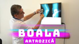 BOALA ARTROZICĂ