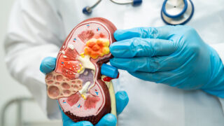 Kidney disease, Chronic kidney disease ckd, Doctor with human mo