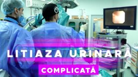 LITIAZA URINARĂ COMPLICATĂ