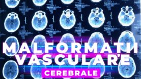 MALFORMAȚII VASCULARE CEREBRALE