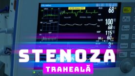 STENOZA TRAHEALĂ: CAUZE ȘI TRATAMENT