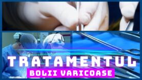 TRATAMENTUL BOLII VARICOASE