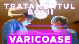 TRATAMENTUL BOLII VARICOASE