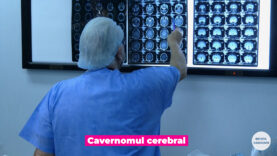 Cavernoame cerebrale.00_00_14_03.Still002