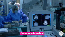 Cavernoame cerebrale.00_00_43_07.Still004