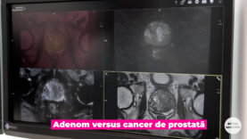 Adenom vs. cancer de prostată.00_01_17_10.Still002