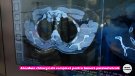 TUMORA PARAVERTEBRALA.00_00_15_13.Still004