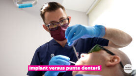 IMPLANT VS PUNTE DENTARA.00_01_49_08.Still001
