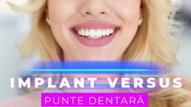 IMPLANT VERSUS PUNTE DENTARĂ