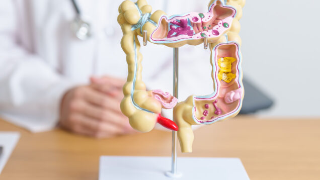 Doctor with human Colon anatomy model. Colonic disease, Large In