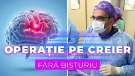 Operații pe creier fără bisturiu