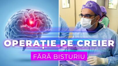 Operații pe creier fără bisturiu